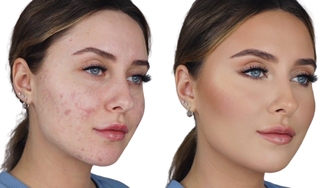 Acne Treatment